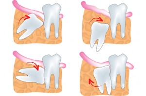 Wisdom Teeth Extraction Roanoke VA